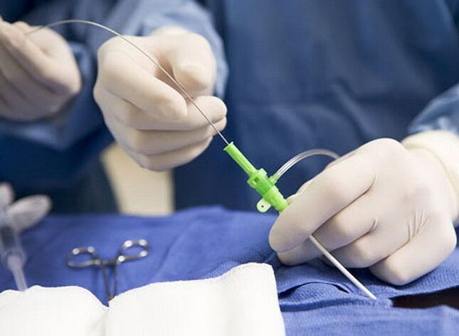 Rádiofrekvenčná ablácia